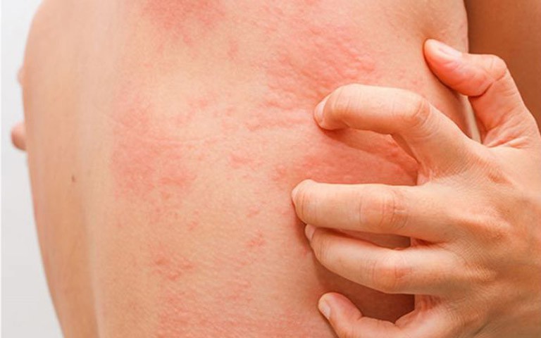 Mùa hè nổi mẩn đỏ, ngứa da, xử trí thế nào?