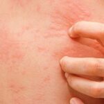 Da nổi mẩn đỏ, ngứa: dấu hiệu dị ứng hay cảnh báo bệnh lý tiềm ẩn?