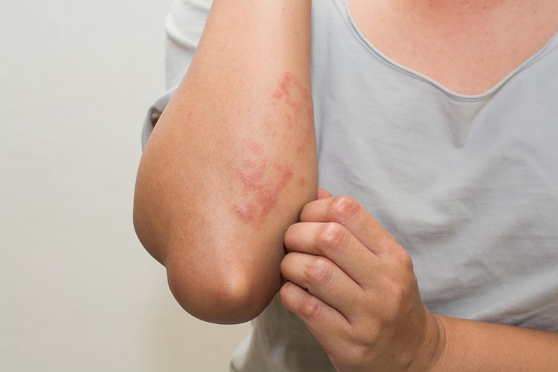 Da nổi mẩn đỏ, ngứa: dấu hiệu dị ứng hay cảnh báo bệnh lý tiềm ẩn?- Ảnh 2. Da nổi mẩn đỏ, ngứa: dấu hiệu dị ứng hay cảnh báo bệnh lý tiềm ẩn?- Ảnh 2.
