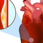 Bỗng dưng bị đau thắt ngực, cảnh giác với nhồi máu cơ tim