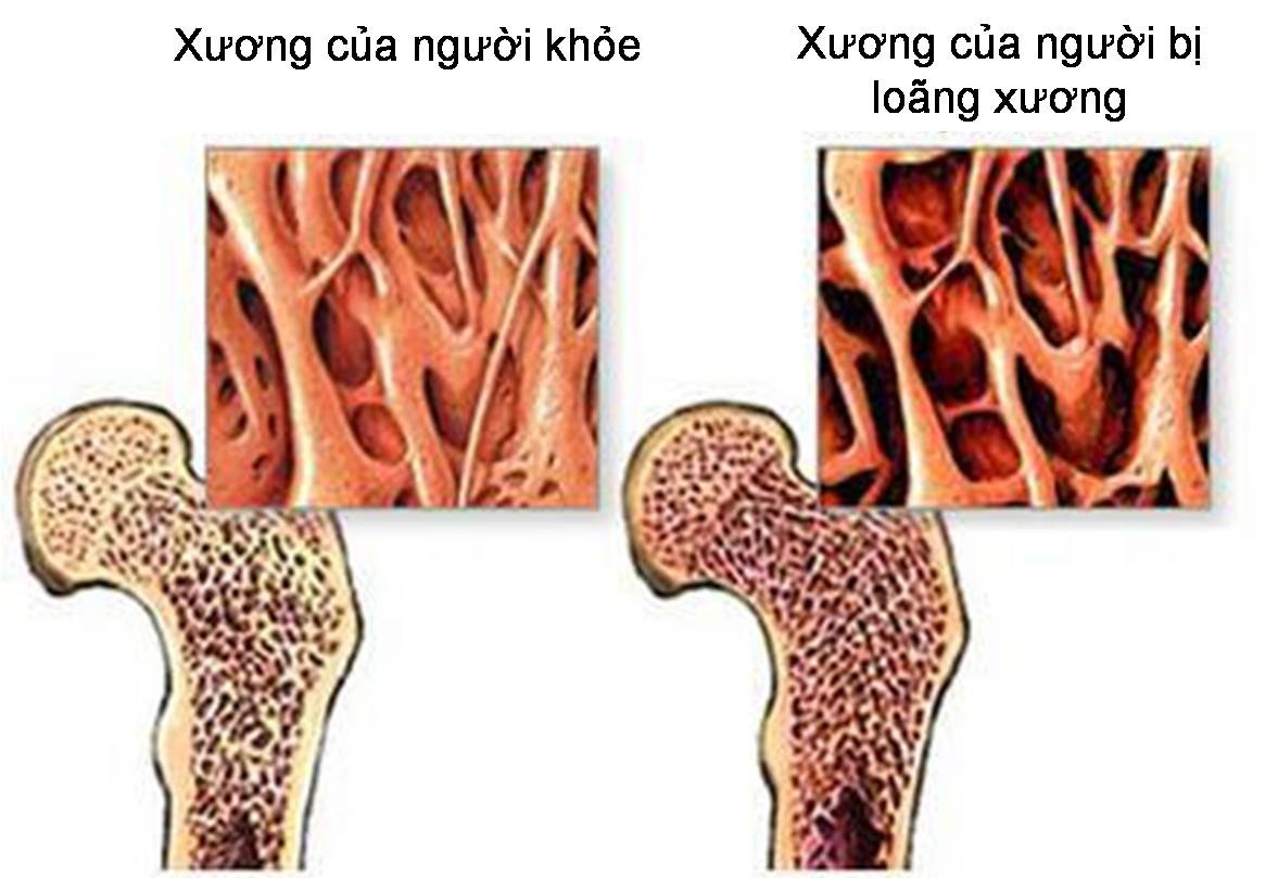 5 giải pháp đơn giản giúp duy trì xương chắc khỏe sau tuổi 50- Ảnh 1. 5 giải pháp đơn giản giúp duy trì xương chắc khỏe sau tuổi 50- Ảnh 1.