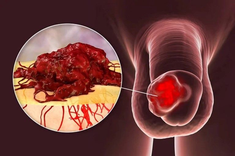Các dấu hiệu sớm của ung thư dương vật- Ảnh 1. Các dấu hiệu sớm của ung thư dương vật- Ảnh 1.