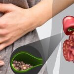 Bệnh sỏi túi mật phổ biến nhưng thường bị xem nhẹ, cảnh báo biến chứng nặng
