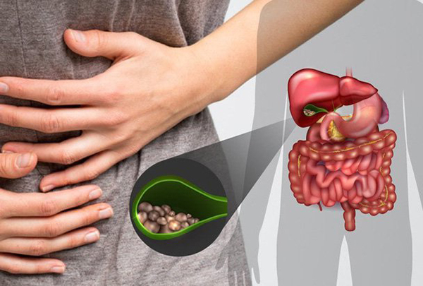 Bệnh sỏi túi mật phổ biến nhưng thường bị xem nhẹ, cảnh báo biến chứng nặng- Ảnh 1.