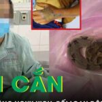 Bị rắn chàm quạp cắn, người đàn ông sưng nề, rối loạn đông máu
