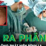 Người đàn ông tiểu ra phân, được phát hiện mắc bệnh lạ