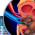 Đau vùng hông lưng, người phụ nữ phát hiện khối u thận
