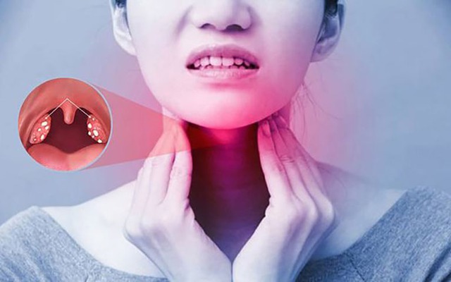 Tại sao viêm họng hạt dễ tái phát?- Ảnh 1. Tại sao viêm họng hạt dễ tái phát?- Ảnh 1.