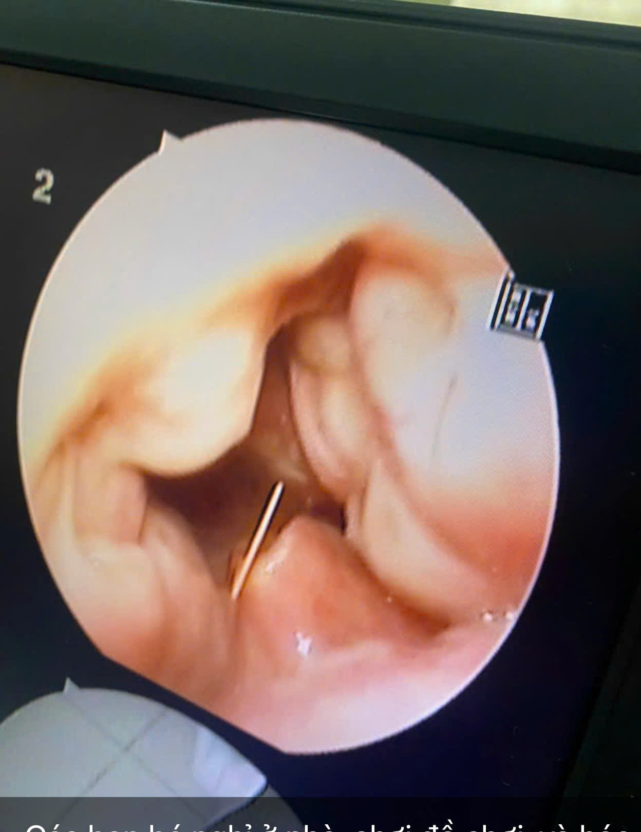 Nhiều trường hợp hóc dị vật đường ăn, chuyên gia khuyến nghị cách xử lý ban đầu- Ảnh 2. Nhiều trường hợp hóc dị vật đường ăn, chuyên gia khuyến nghị cách xử lý ban đầu- Ảnh 2.