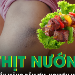 Bé trai nổi đầy mảng bầm tím sau bữa ăn thịt nướng, bác sĩ phát hiện nguyên nhân bất ngờ