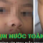 Bé trai 4 tuổi nổi kín mụn nước toàn thân sau khi mắc cùng lúc zona thần kinh và thủy đậu