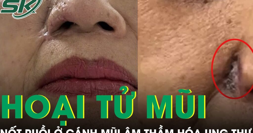 Nốt ruồi ở cánh mũi âm thầm hóa ung thư, phá hủy gần toàn bộ mũi người phụ nữ