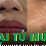 Nốt ruồi ở cánh mũi âm thầm hóa ung thư, phá hủy gần toàn bộ mũi người phụ nữ