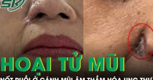 Nốt ruồi ở cánh mũi âm thầm hóa ung thư, phá hủy gần toàn bộ mũi người phụ nữ