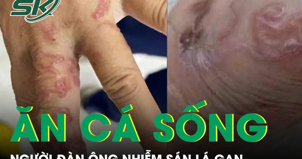 Ăn cá sống, người đàn ông bị nhiễm sán lá gan