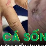 Ăn cá sống, người đàn ông bị nhiễm sán lá gan