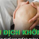 Tràn dịch khớp gối nên kiêng ăn gì để hạn chế tái phát và biến chứng?
