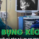 Bé gái 11 tuổi đau bụng kéo dài phát hiện khối bã tóc dài 20 cm trong dạ dày