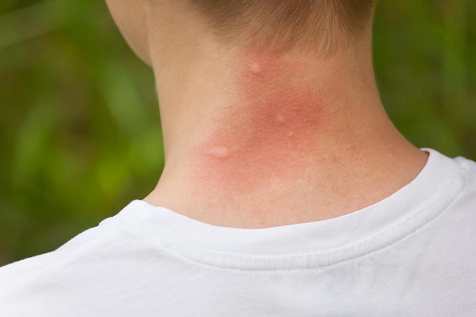 Nhận biết vết côn trùng cắn, đốt và cách xử trí đúng để tránh biến chứng nguy hiểm- Ảnh 2. Nhận biết vết côn trùng cắn, đốt và cách xử trí đúng để tránh biến chứng nguy hiểm- Ảnh 2.