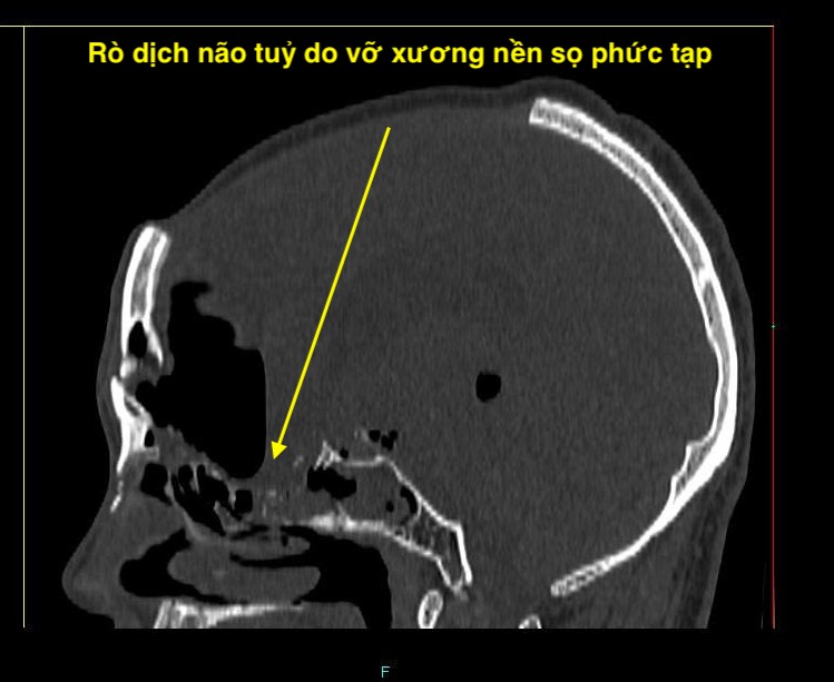 Vá rò dịch não tủy qua đường mũi, cứu 2 bệnh nhân trẻ- Ảnh 2. Vá rò dịch não tủy qua đường mũi, cứu 2 bệnh nhân trẻ- Ảnh 2.