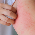 Sử dụng thuốc gì khi nổi mề đay, mẩn ngứa?