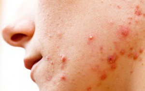 Tại sao ăn chuối lại gây nổi mụn?- Ảnh 2. Mụn trứng cá bọc có nên nặn không?