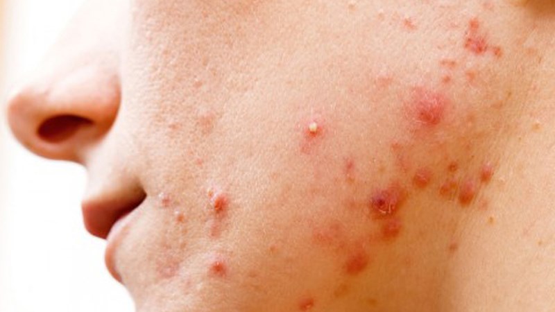 Mụn trứng cá bọc có nên nặn không?- Ảnh 1. Mụn trứng cá bọc có nên nặn không?- Ảnh 1.