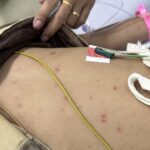 TPHCM: Cứu sống bé 7 tuổi mắc não mô cầu nhóm B diễn tiến nhanh