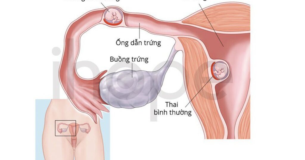 Hiếm gặp: Vừa có thai trong tử cung vừa có thai ngoài tử cung