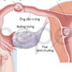 Hiếm gặp: Vừa có thai trong tử cung vừa có thai ngoài tử cung