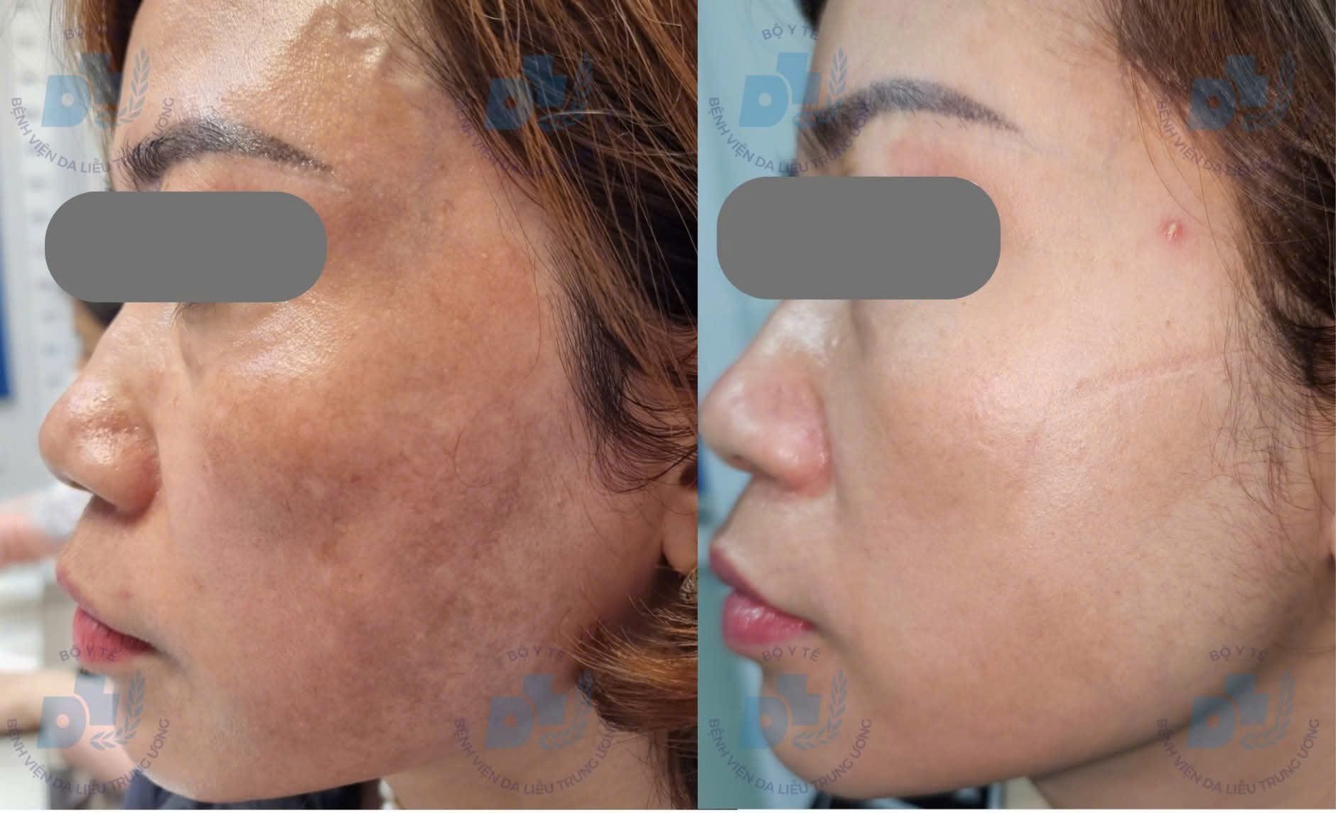 Bác sĩ chỉ rõ lý do nhiều người trị nám tốn kém nhưng vẫn tái phát- Ảnh 2. Bác sĩ chỉ rõ lý do nhiều người trị nám tốn kém nhưng vẫn tái phát- Ảnh 2.