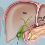 6 dấu hiệu ung thư tụy, nhận biết sớm để điều trị kịp thời