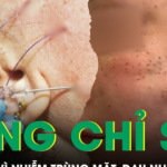 Căng chỉ nâng cơ ở spa, người phụ nữ nhập viện vì nhiễm trùng mặt