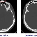 Bệnh viện Việt Nam – Thụy Điển Uông Bí phẫu thuật thành công ca u xương sọ hiếm gặp