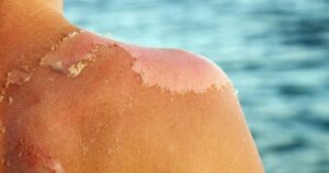 Bỏng nắng phải làm gì để tránh tổn thương da nghiêm trọng?