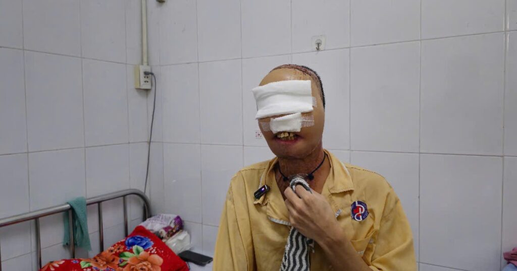 Hành trình ‘làm lại gương mặt’ cho chàng thanh niên mang di chứng bỏng suốt 3 năm