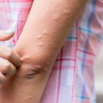Mề đay dễ bùng phát khi nắng nóng: 3 cách làm giảm ngứa, dịu da