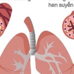 Khi nào người bệnh hen cần đến viện ngay lập tức?