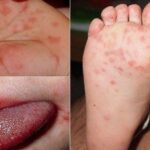 Khánh Hòa đã ghi nhận 2.254 ca tay chân miệng, bác sĩ khuyến cáo điều cần nhớ để phòng bệnh