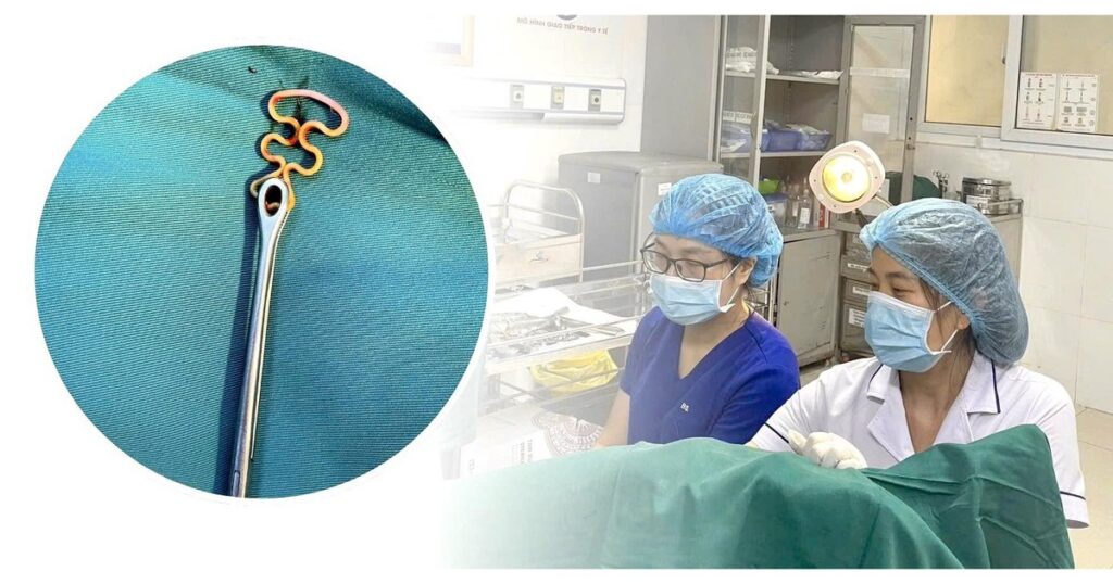 Bỏ quên vòng tránh thai suốt 30 năm, người phụ nữ 63 tuổi gặp biến chứng phụ khoa