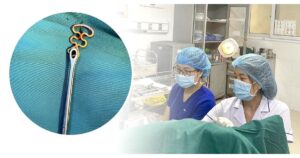 Bỏ quên vòng tránh thai suốt 30 năm, người phụ nữ 63 tuổi gặp biến chứng phụ khoa