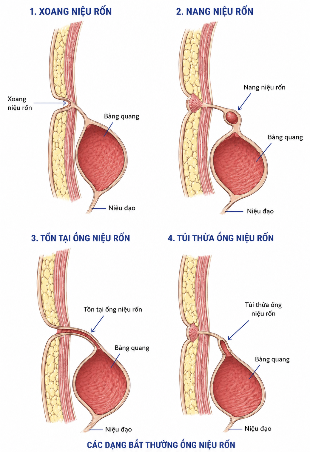 xoang-nieu-ron-2-17793705216381542362289 Bệnh viện Quân y 354: Phẫu thuật thành công ca xoang niệu rốn hiếm gặp ở người trưởng thành- Ảnh 2.