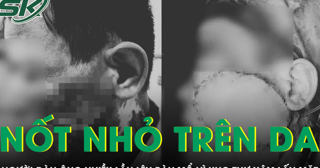 Chủ quan với nốt nhỏ trên da, người đàn ông nhiều lần phẫu thuật ung thư xâm lấn tái phát
