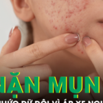 Tự nặn mụn quanh môi, cô gái nhập viện vì áp xe mặt, nhiễm vi khuẩn kháng thuốc