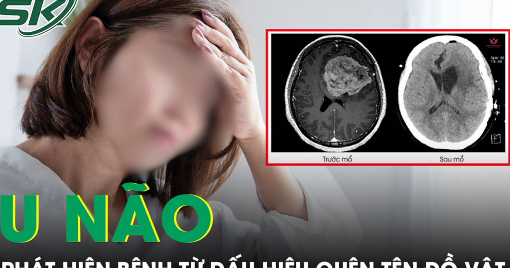 Liên tục quên tên đồ vật quen thuộc, người phụ nữ phát hiện khối u não nguy hiểm