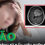 Liên tục quên tên đồ vật quen thuộc, người phụ nữ phát hiện khối u não nguy hiểm