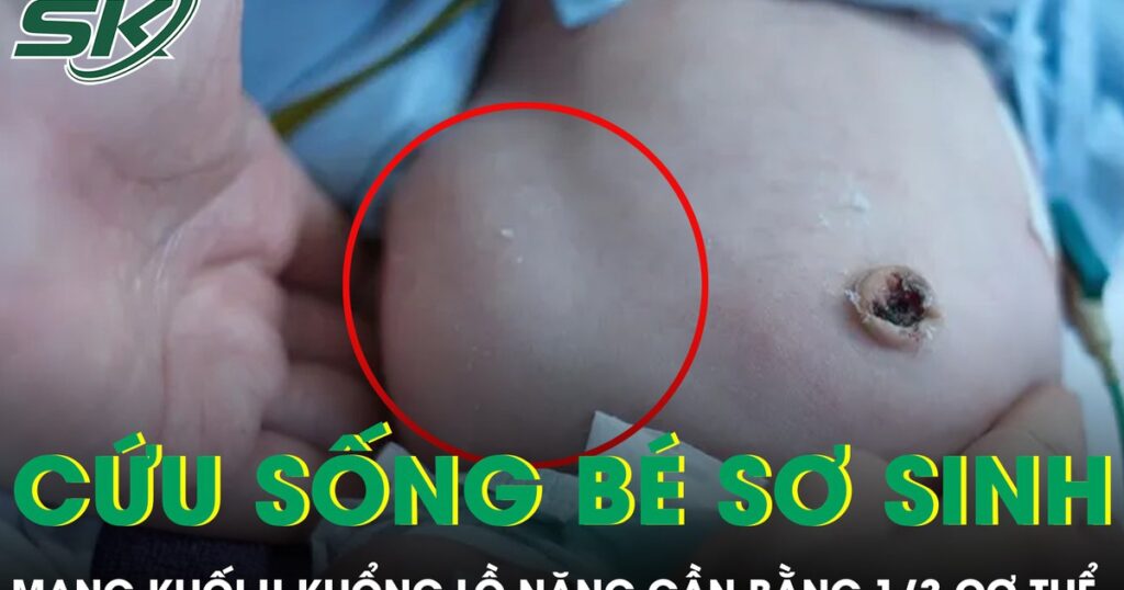 Cứu sống bé sơ sinh mang khối u khổng lồ nặng gần bằng 1/3 cơ thể