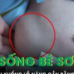 Cứu sống bé sơ sinh mang khối u khổng lồ nặng gần bằng 1/3 cơ thể