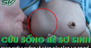 Cứu sống bé sơ sinh mang khối u khổng lồ nặng gần bằng 1/3 cơ thể