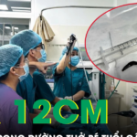Bé 8 tuổi ho nhiều, bác sĩ phát hiện con đỉa dài hơn 12 cm trong đường thở